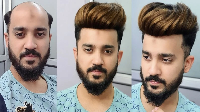 Anas Sheikh Hair Solution pune